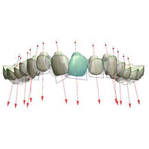 Esempio di trattamento ortodontico per denti storti a Montecatini