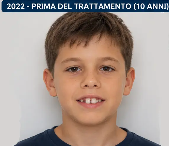 Foto prima e dopo trattamento: Il sorriso a 12 anni - Studio Dentistico La Scala