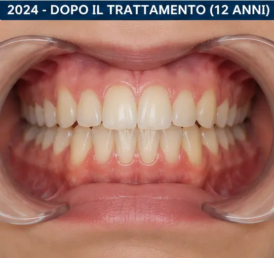 Sorriso alla fine del trattamento - Dettaglio